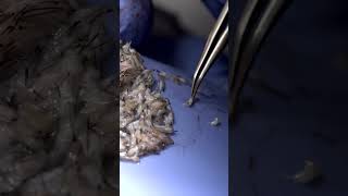 WATCH this Incredible Hair Transplant 3000 grafts Care4Hair [upl. by Yvel715]