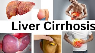 Liver CirrhosisAmharic Tutorial [upl. by Leonid]