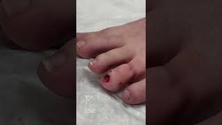 Onychomycosis Yellow Toe Nail removed [upl. by Grosmark]