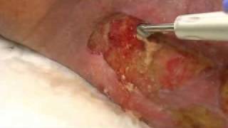 Demonstration Yellow slough removed via Qoustic Wound Therapy System [upl. by Sturrock909]