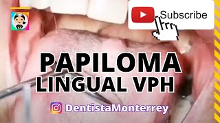 VIRUS DEL PAPILOMA HUANO VPH👅PAPILOMA LINGUAL CAUSAS [upl. by Soo]