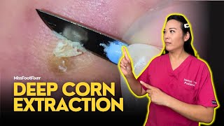 Deep Foot Corn Extraction Satisfying Removal Technique  FootClinicLondoncouk [upl. by Benedicta]