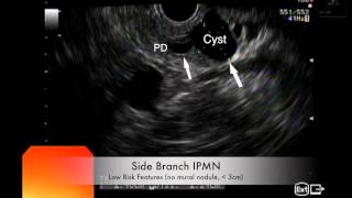 EUS Side Branch IPMN [upl. by Imekawulo]