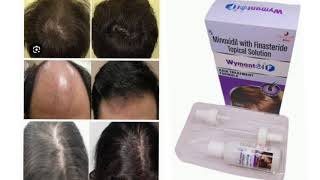 Wymante F Topical Solution Minoxidil with Finasteride Topical Solution [upl. by Redfield478]