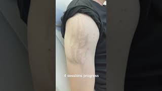 Laser tattoo removal results lasertattooremoval beforeandafter skincare tattoos satisfying [upl. by Long]