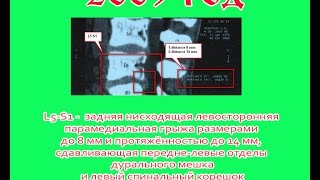 Грыжа позвоночника 14 мм 5 лет тренировок Результаты [upl. by Amos]