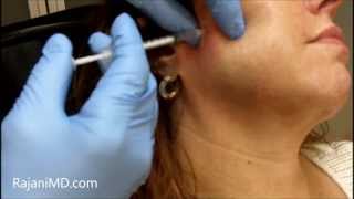 Watch Botox Facial Shaping and TMJRajani [upl. by Adelheid491]