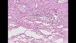 Histopathology ColonIschemic enterocolitis [upl. by Ayhtak542]