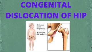 congenital of hip dysplasia [upl. by Hinckley]