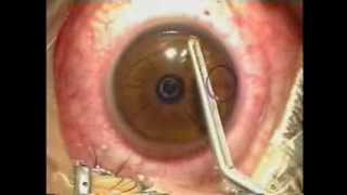 Lasik Laser Eye Surgery Procedure  Live Surgery [upl. by Bettencourt]