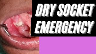 How to treat a Dry Socket drysocket [upl. by Daye97]