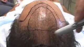 HAIR TRANSPLANT DALLAS EDUCATIONAL LECTURE 5 [upl. by Benjamen]