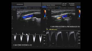 stenosi dellarteria carotide interna sinistra  ICA [upl. by Hiltan]