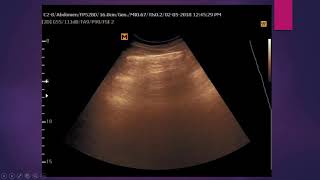 Focal Fat sparing of the liver parenchyma [upl. by Kieger]