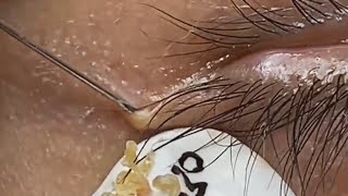 Extraction profonde des points noirs Acné kystique et popping 13 [upl. by Aikel]