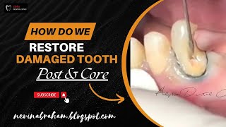 Damage से Restoration तक Post amp Core Dental Procedure का व्याख्या [upl. by Sussman252]