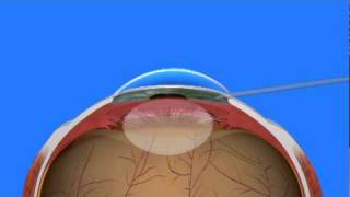 Cataract Surgery [upl. by Asiak]