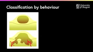 What are the differences between benign amp malignant tumours [upl. by Adina]