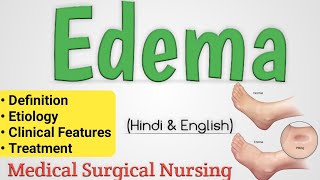 Edema  Edema In Hindi  Oedema [upl. by Ardnaek550]