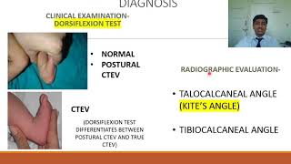 Congenital Talipes Equino Varus CTEV  Rapid Revision of Orthopaedics by Dr Prateek Joshi [upl. by Corwin]