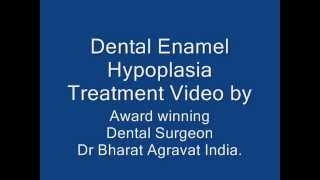 Dental Teeth Enamel Hypoplasia Video by Award winning Dental Surgeon Dr Bharat Agravat India [upl. by Adlaremse959]