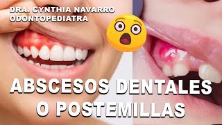 🤔😩 ¿Por qué salen abscesos o postemillas en la boca [upl. by Eiralav154]