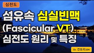 섬유속 심실빈맥fascicular VT fascicular ventricular tachycardia 심전도ecg 이해 [upl. by Violante]