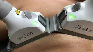 SculpSure for Treatment of Grade I Gynecomastia [upl. by Novelc]