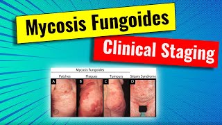 Staging of Mycosis fungoides MF  video series for dermatology residency and USMLE [upl. by Nnaes677]