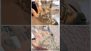 Healing process for laser tattoo removal [upl. by Berthe]