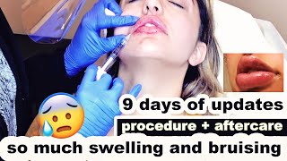 LIP FILLERS  First time tips for faster healing [upl. by Deb]