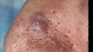 Pimples Popping On Nose Part 1 [upl. by Avitzur346]