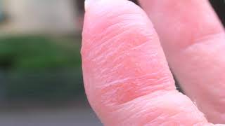 Learn about dyshidrosis  what is eczema on hands [upl. by Levania691]