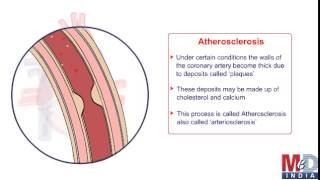 Coronary Artery Bypass Surgery [upl. by Tnelc]