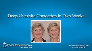 Deep Overbite Correction in Two Weeks [upl. by Anahtor]