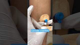 Cannula insertion of male patient nurses cannula shorts neet ytshorts youtubeshorts subscribe [upl. by Nawed881]