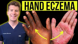 Doctor explains how to recognise and treat HAND ECZEMA dermatitis  Causes symptoms amp prevention [upl. by Elok]