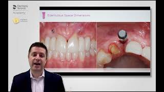 Putting Both Horizontal amp Vertical Space Considerations Into Implant Planning [upl. by Oemac]