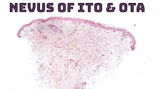 Nevus of Ito Ota Sun Hori amp Dermal Melanocytosis quotMongolian Spotquot under the microscope dermpath [upl. by Silvan]