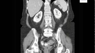 Diverticulitis on CT Scan [upl. by Ariada]