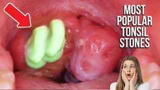 Tonsil Stones Removal Causes Symptoms Cotton Swab Treatment [upl. by Yks]