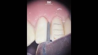 Incisal edge reduction after depth cutter Bur 850314016 was usedpreparation veneers [upl. by Vitkun232]