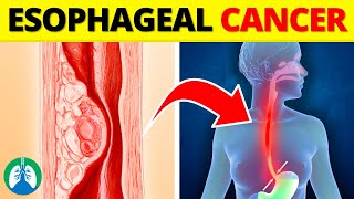 Top 10 Early Warning Signs of Esophageal Cancer  NEVER Ignore THIS [upl. by Kolivas]