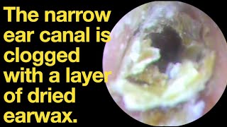 The narrow ear canal is clogged with a layer of dried earwaxear wax removal  ear cleaning  ASMR [upl. by Amelie]