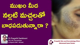 ముఖం మీద నల్లటి మచ్చలతో బాధపడుతున్నారా  facial melanosis  Dr Pragathi  Dermatologist  Nizamabad [upl. by Atinid484]