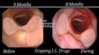 Endoscopic Evaluation of the Tracheal Allotransplant [upl. by Lonny]