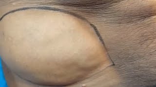 Giant Lipoma treatment [upl. by Eillat]