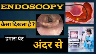 Endoscopy  Endoscopy procedure  Endoscopy Kaise Hoti hai pet ki video [upl. by Luise]