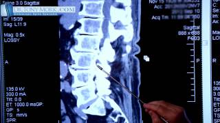 Spondylosis by Dr Tony Mork [upl. by Mikes]