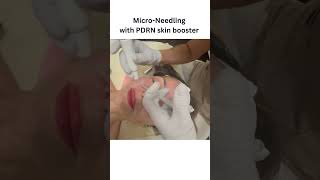 Micro Needling with PDRN skin booster [upl. by Divd]